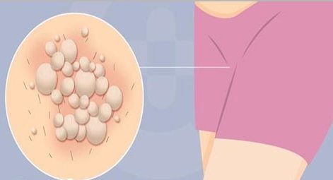 Phương pháp trị bệnh lậu vùng kín nữ hiệu quả cao