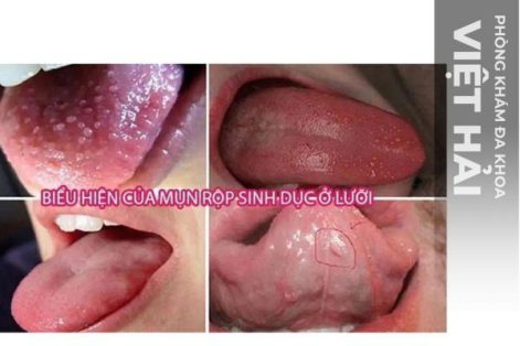 Cách trị mụn rộp ở lưỡi hiệu quả hiện nay