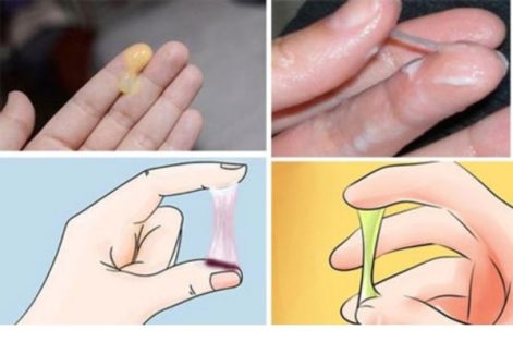 Âm đạo chảy dịch là bị bệnh gì?