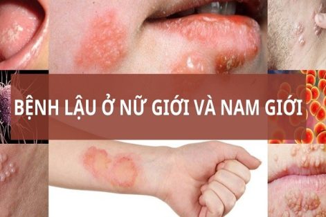 Triệu chứng bệnh xã hội không khó nhận biết