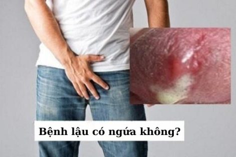 Nhiễm bệnh lậu có ngứa không?