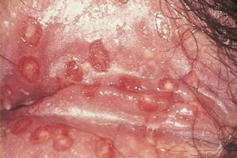 Cẩn thận với bệnh lậu sinh dục nữ