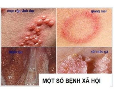 Chi phí xét nghiệm bệnh xã hội hiện nay bao nhiêu?