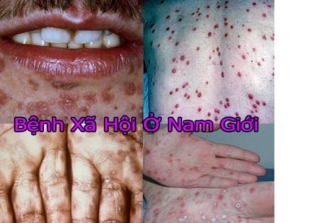 Dấu hiệu bệnh xã hội nam