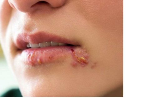 Cách chữa bệnh xã hội ở miệng hiệu quả cao