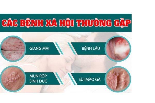benh-xh-thuong-gap