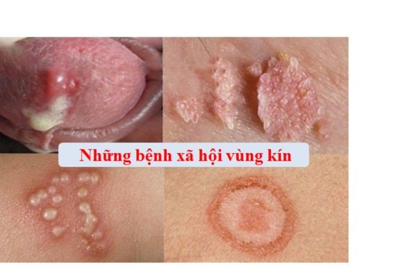 benh-xh-vung-kin