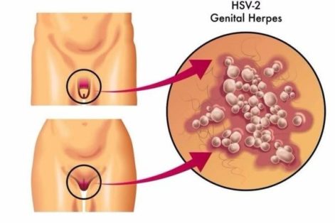 Herpes âm hộ và những điều cần biết