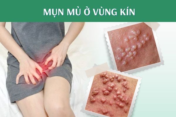 cach-chua-mun-mu-o-vung-kin-2