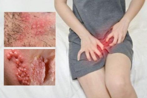 Chim nổi mẩn đỏ – Nguyên nhân và cách điều trị