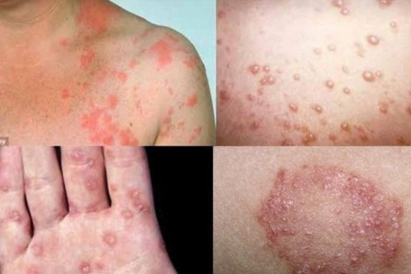 chữa bệnh lậu bằng dha
