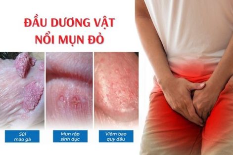 Cảnh giác với tình trạng đầu dương vật nổi mụn đỏ