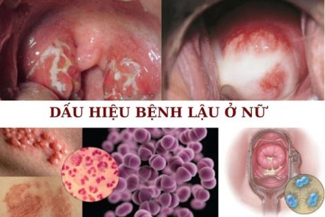 Dấu hiệu bệnh lậu ở nữ như thế nào?