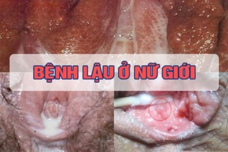 Dấu hiệu bệnh lậu ở nữ giới như thế nào?