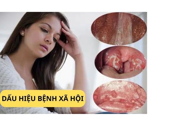 dau-hieu-benh-xh