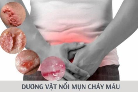 Dương vật nổi mụn chảy máu – Dấu hiệu bệnh lý nguy hiểm