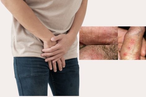 Herpers sinh dục nam dấu hiệu nhận biết và cách chữa