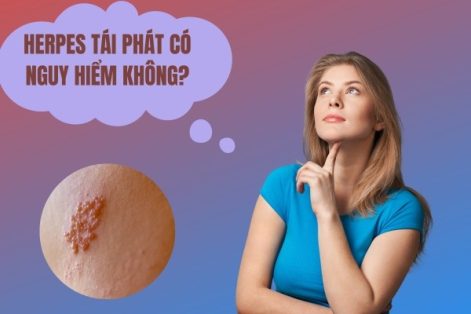 Tái phát Herpes sinh dục có nguy hiểm không?
