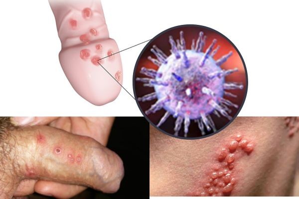 herpes-duong-vat-1