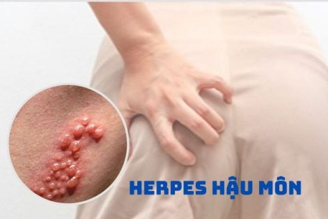 Dấu hiệu và biến chứng nguy hiểm của bệnh Herpes hậu môn