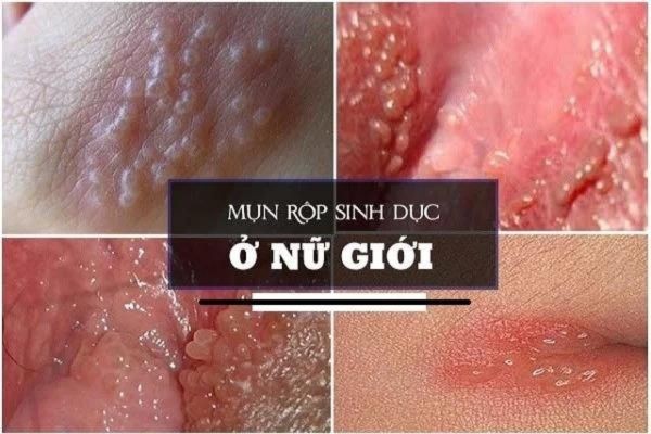 herpes-sinh-duc-nu-1