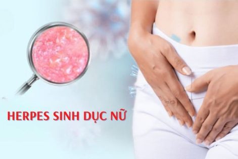 Những thông tin về bệnh herpes sinh dục nữ