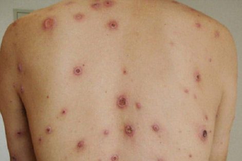 Dấu hiệu bệnh xã hội: Nhận thấy đi khám chữa ngay