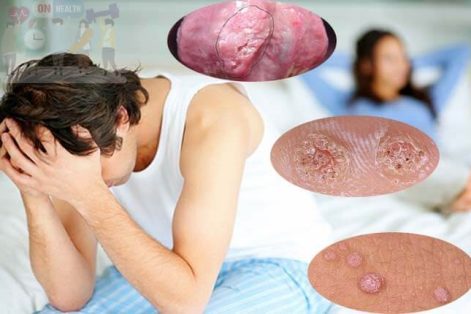 Nguyên nhân và tác hại nguy hiểm của bệnh mụn cóc sinh dục nam