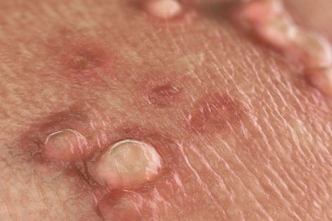 Chữa HPV bằng phương pháp nào hiệu quả?