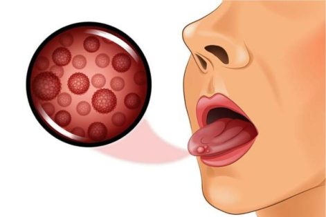 Mụn đỏ ở lưỡi là bị bệnh gì?