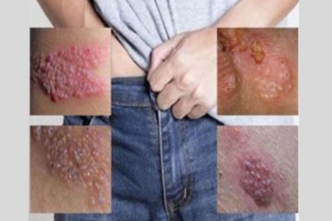 Nguyên nhân gây nổi mụn đỏ vùng kín nam giới