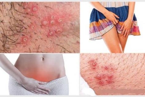 Mụn đỏ vùng kín nữ và những bệnh lý liên quan
