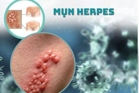 Mụn Herpes và những thông tin cần biết