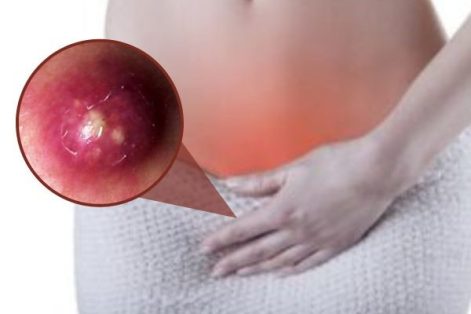Mụn mủ âm vật – Dấu hiệu bệnh xã hội nguy hiểm