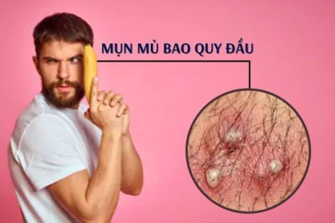 Mụn mủ bao quy đầu – Cảnh báo bệnh lý nguy hiểm