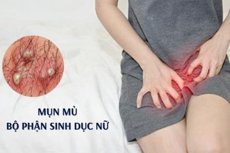 Mụn mủ bộ phận sinh dục nữ là dấu hiệu bệnh gì?