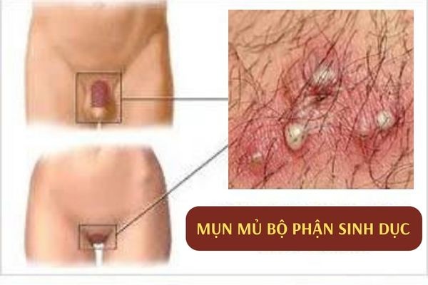 mun-mu-bo-phan-sinh-duc