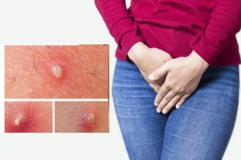 Cảnh giác khi xuất hiện mụn mủ cô bé