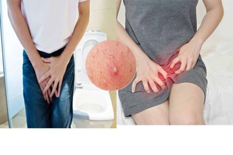 Cách chữa mụn nhọt ở vùng kín hiệu quả