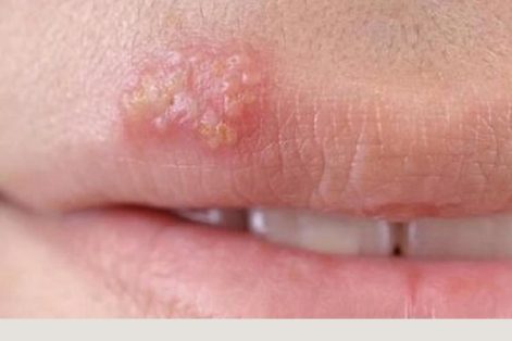 Mụn rộp ở miệng là bị bệnh gì?