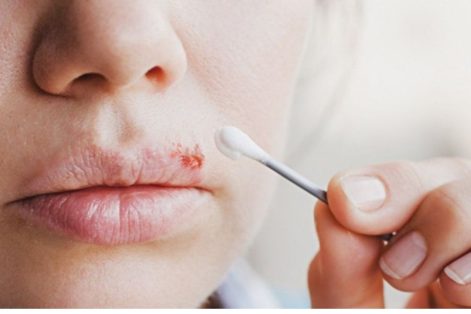 Bệnh Herpes miệng do đâu? Cách điều trị như thế nào