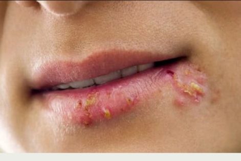 Mụn rộp sinh dục ở miệng là bệnh gì?