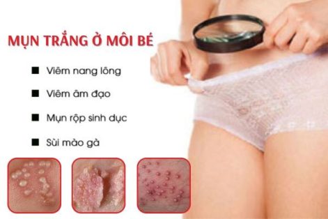 Cẩn thận với tình trạng nổi mụn trắng ở môi bé