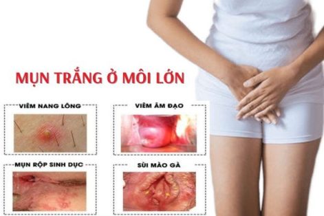 Mụn trắng ở môi lớn – Triệu chứng bệnh lý nguy hiểm