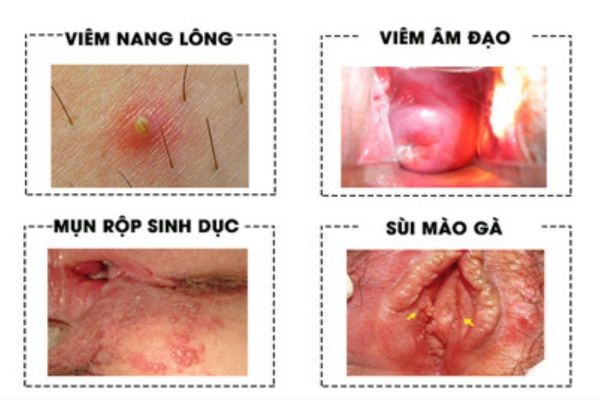 mun-trang-o-vung-kin-nu-1