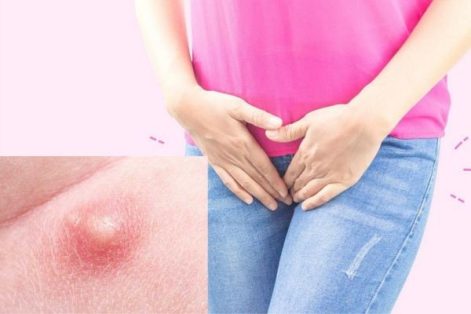 Hết sức thận trọng với mụn trắng ở vùng kín nữ