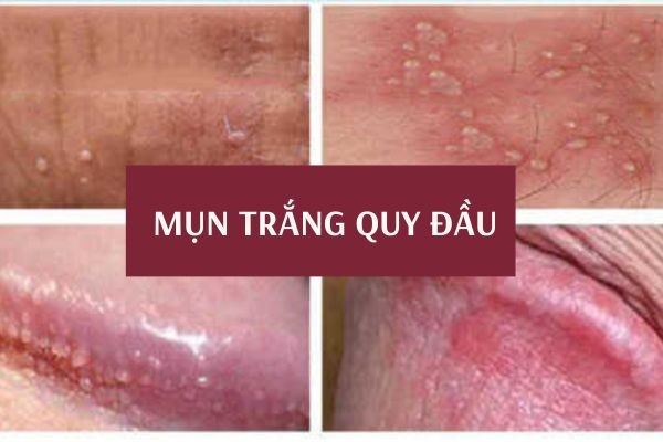 mun-trang-quy-dau-1