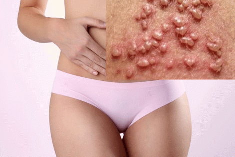 Nổi mụn trắng âm đạo là bị bệnh gì?
