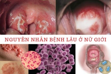 Nguyên nhân bệnh lậu ở nữ giới là gì?