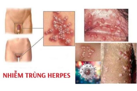 Nhiễm trùng Herpes là bệnh gì?